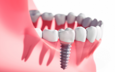 Impianti dentali: le soluzioni per ritrovare un sorriso funzionale e completo