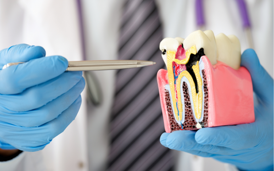 Prevenzione carie: come evitare la formazione di buchi nei denti