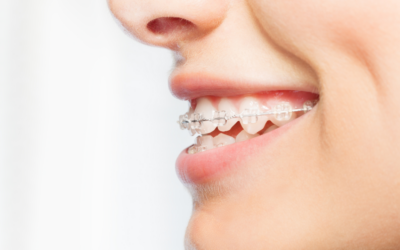 Come curare la malocclusione dentale con l’ortodonzia