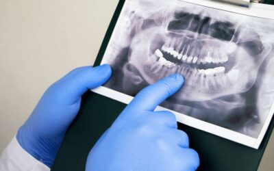 Impianto denti senza osso: si può fare?