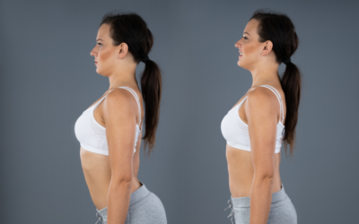 Cifosi dorsale: le alterazioni posturali