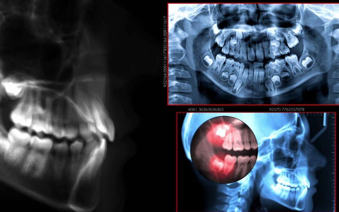 Diagnosi odontoiatrica: le radiografie necessarie