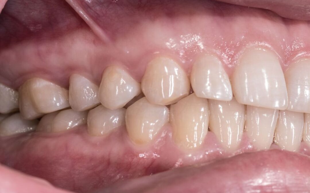 intercuspidazione dei denti