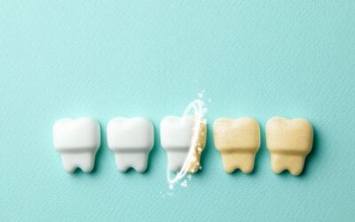 Denti ingialliti: le cause e le soluzioni