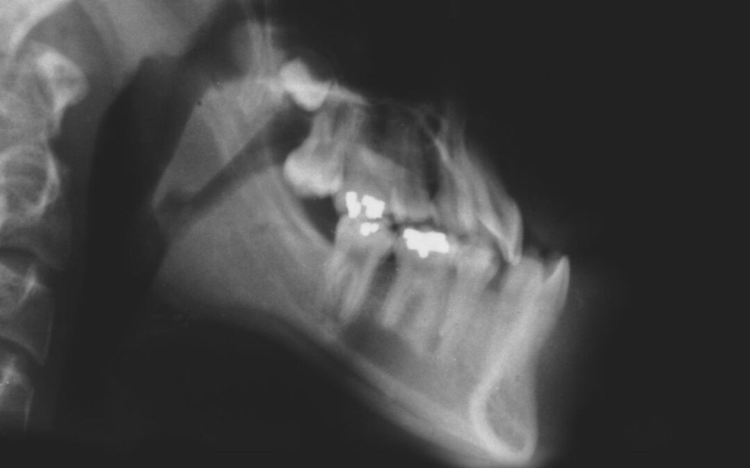 prognatismo mandibolare