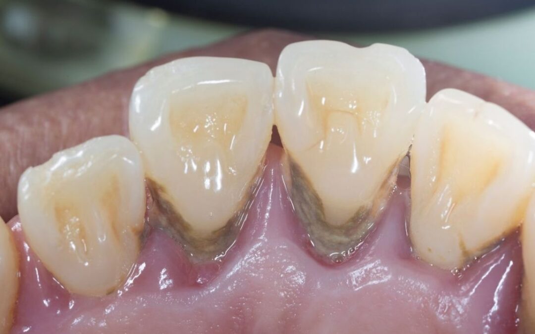 parodontite dentale