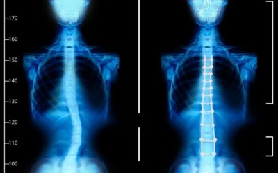 Le curvature anomale della colonna vertebrale: a cosa possono essere dovute?