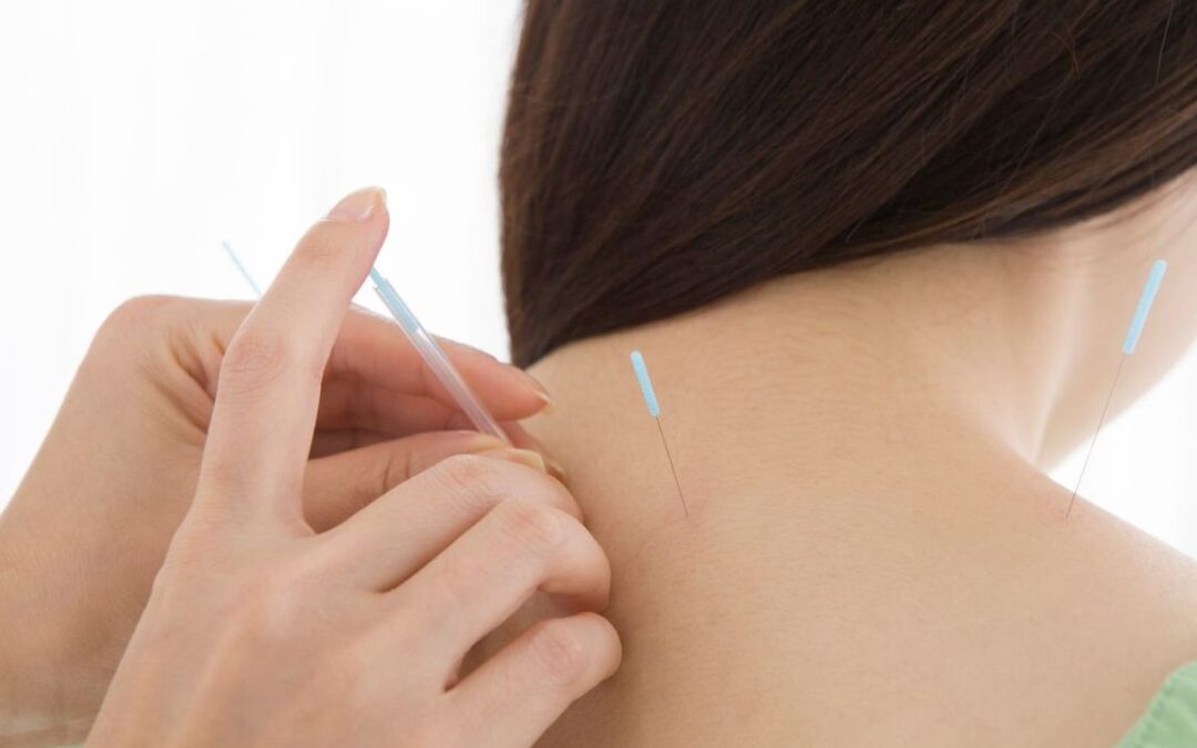 Agopuntura per cervicale, la soluzione per dire addio al dolore